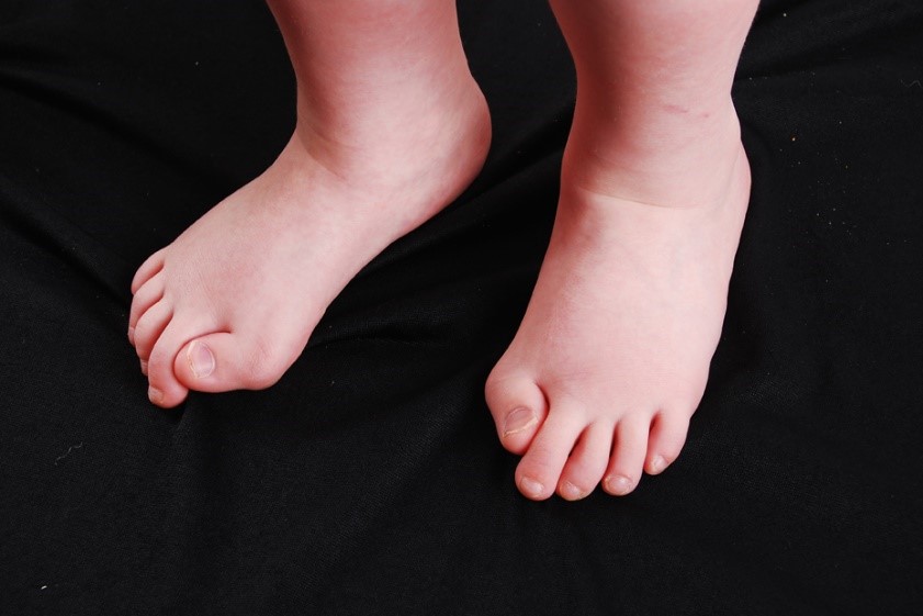 Congenital hallux valgus Rare Care World
